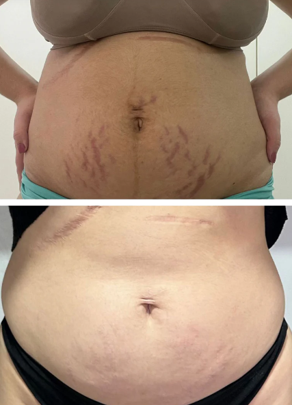Antes e Depois Estrias 1
